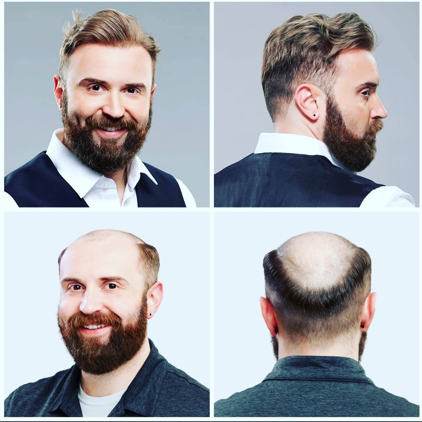 men's hair replacement